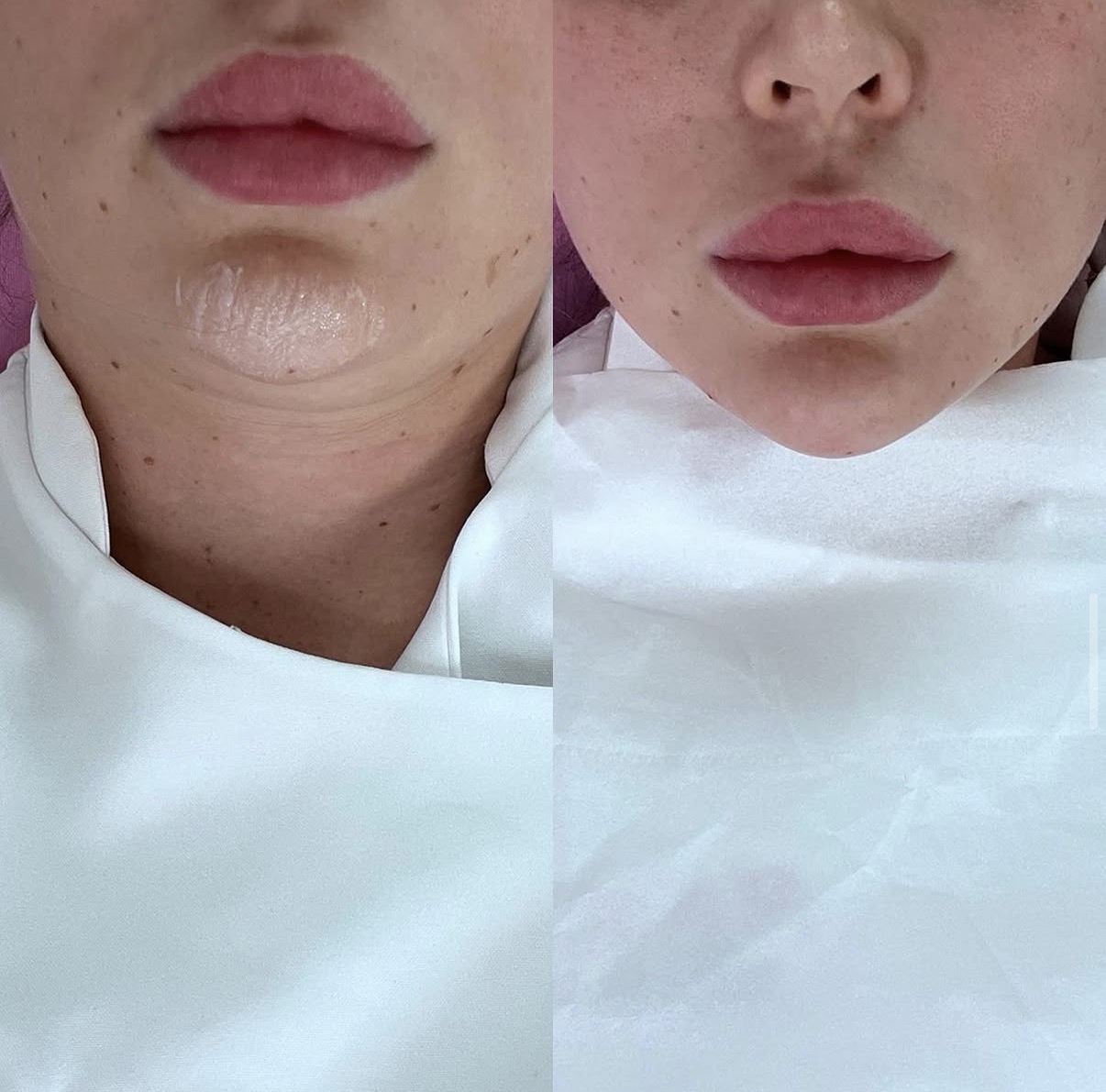 Chin filler 1ml dermal filler result