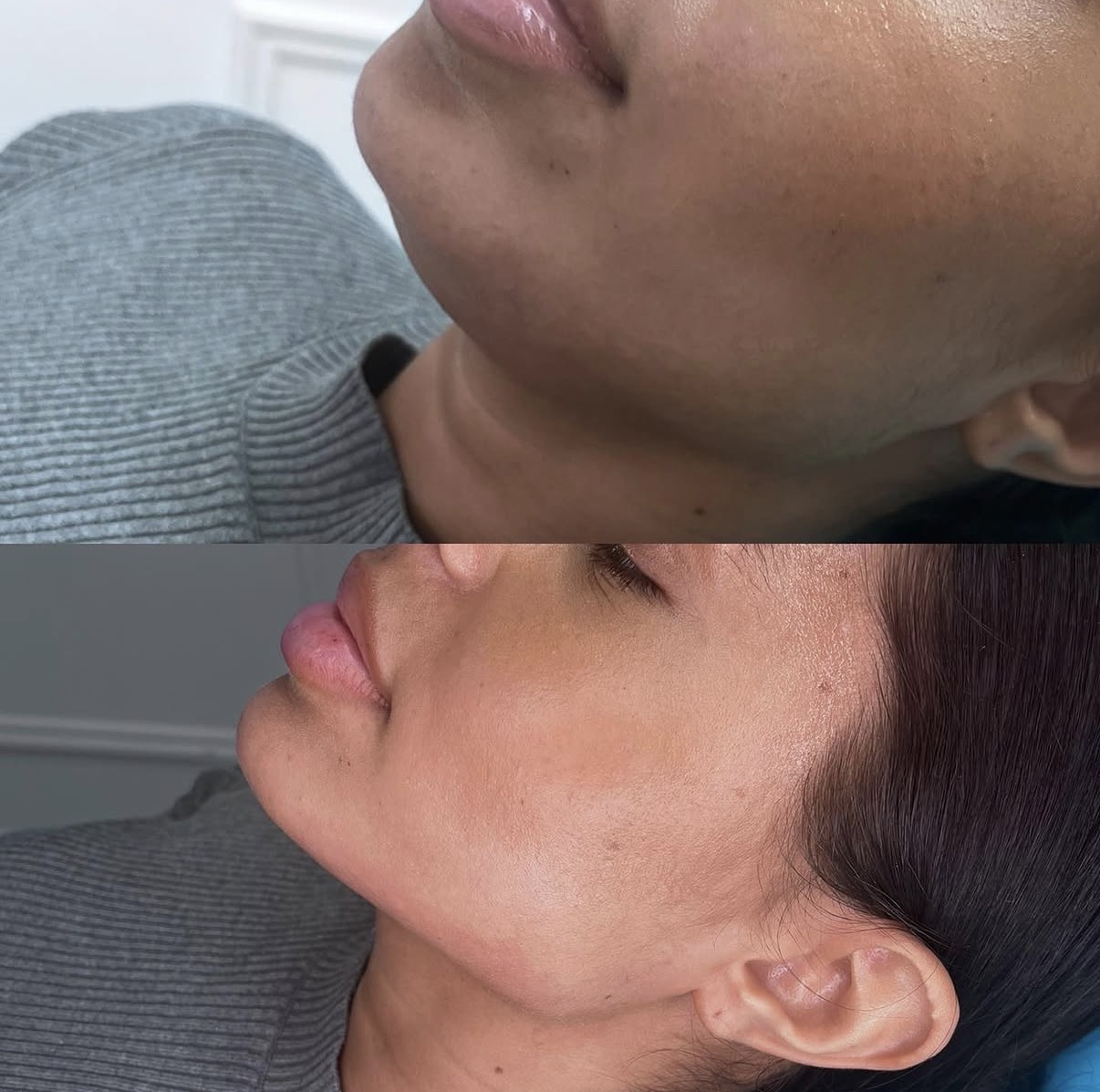 Jawline contour 2ml dermal filler result