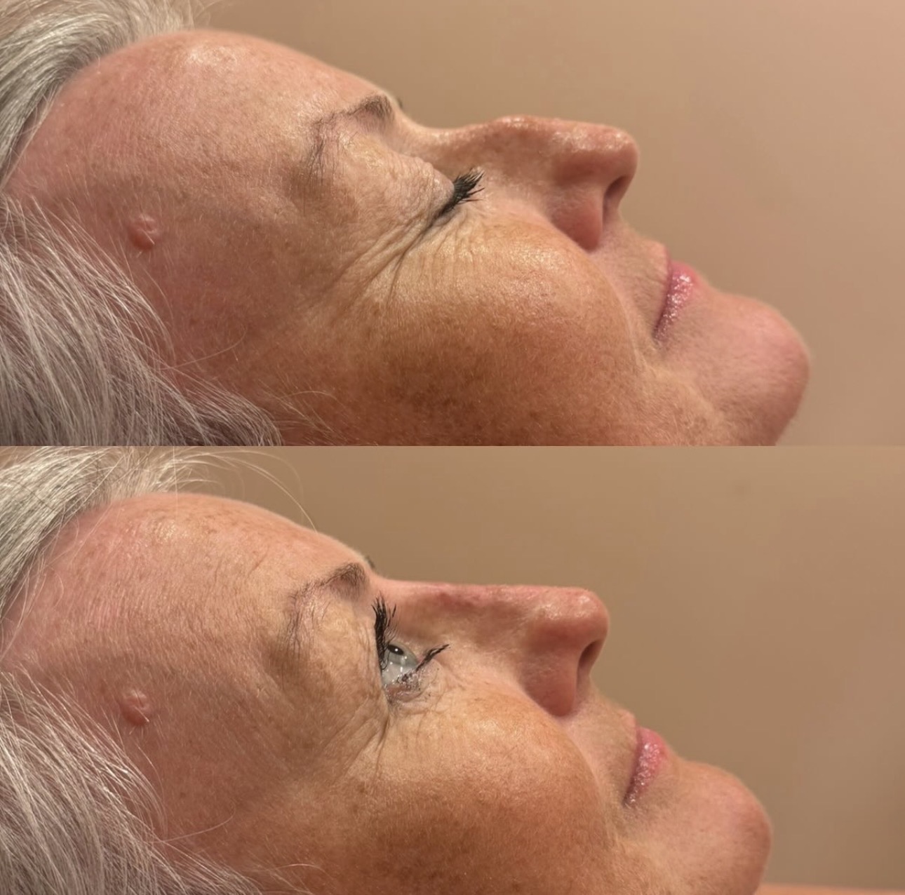 Non-Surgical Rhinoplasty Professional Image