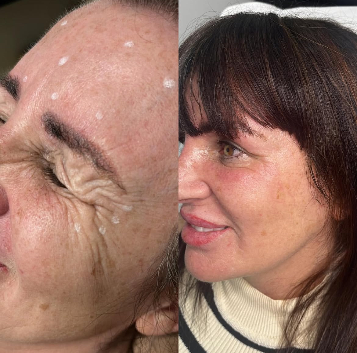 Botox Treatment Results