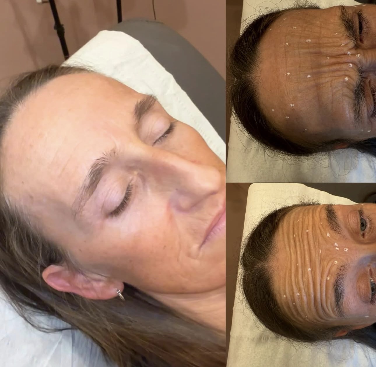 Botox Treatment Results