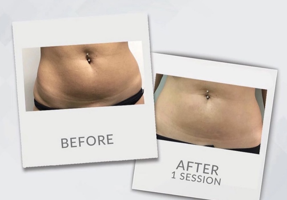 Fat Dissolving Treatment - ClearCosmetics Professional Service