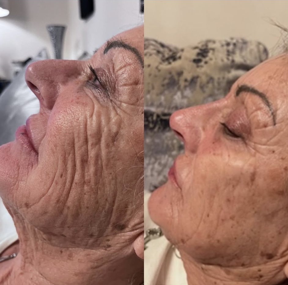 Skin Booster Treatment - ClearCosmetics Professional Service